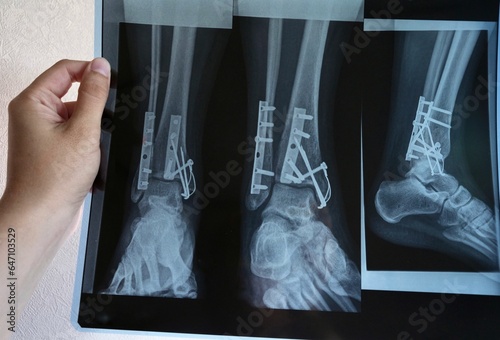 Konstfotografi X-ray, a picture of the leg bones after surgery in the hands of a doctor