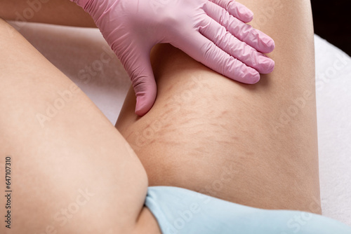 The beautician makes injections of blood plasma on the thighs of a woman. Treatment of skin stretch marks in the clinic.