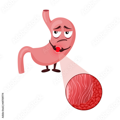Cartoon stomach character with gastritis, inflammation in mucosa layer under magnification