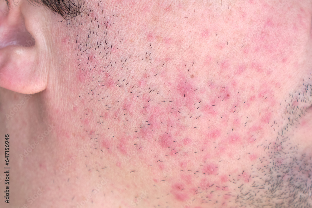 Dermatitis on man face. Eczema close up. Dermatitis on man face. Eczema close up.