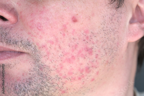 Dermatitis on man face. Eczema close up.