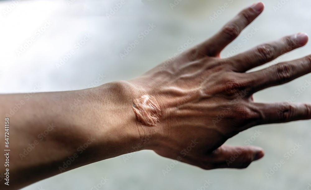 Fototapeta premium Close-up of scars on hands skin imperfections or defects caused by an accident scar healthcare concept
