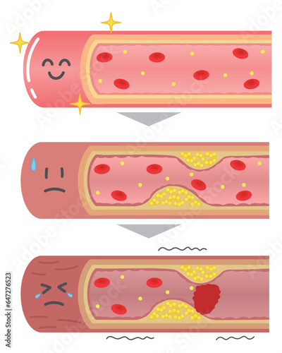 進行する動脈硬化の血管断面図の表情付きイラスト