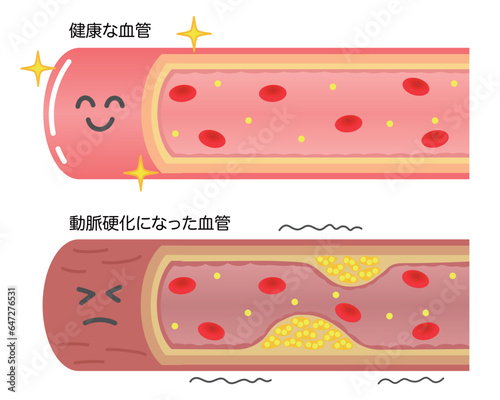 健康な血管と動脈硬化で狭窄した血管の比較イラスト photo