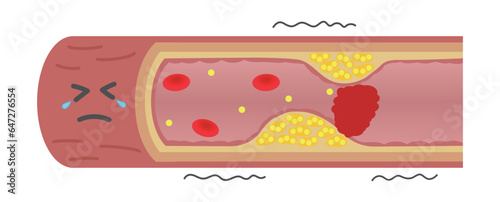 血栓で閉塞して苦しそうな動脈硬化の血管のイラスト（横）
