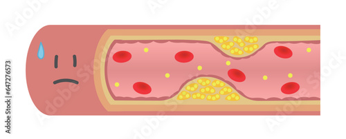 動脈硬化で内部が狭窄して困っている血管のイラスト（横）