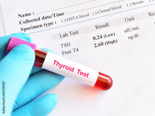 Blood sample tube with abnormal thyroid hormone test result photo