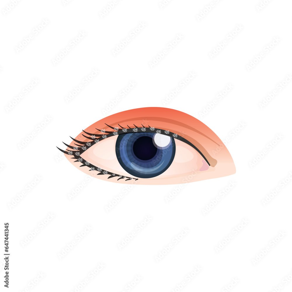 Blepharitis Syndrome Concept Design. Vector Illustration. Blepharitis Syndrome Concept Design. Vector Illustration.