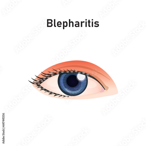 Blepharitis Syndrome Concept Design. Vector Illustration.
