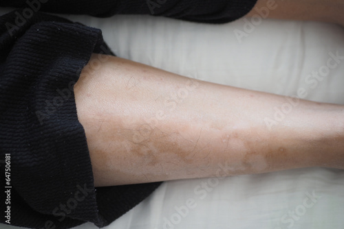 feet with vitiligo skin condition.