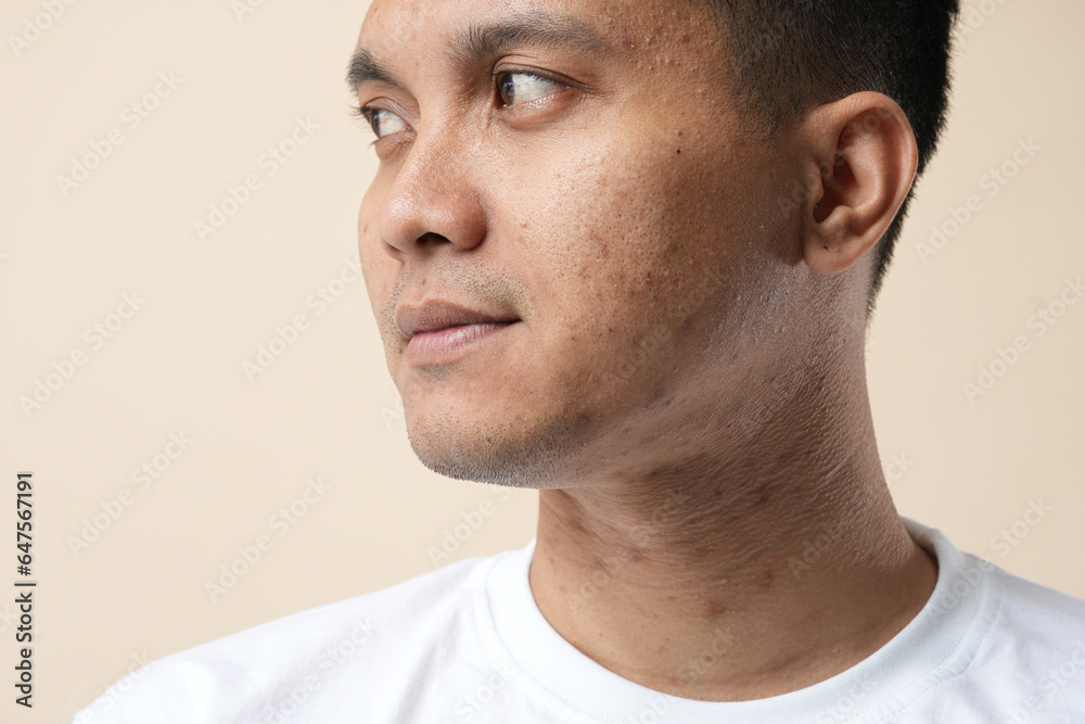Obraz premium Profile of Asian young man with problem skin, isolated on a cream background.