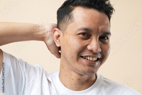  A Photo of Acne and pores on the face of a young Asian man. Improper therapy has led to a form of inflammation face and isolated on a cream background.