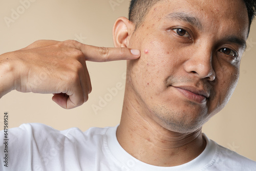 Photo of an Asian man with problematic skin. Acne and red pimples on the face of a young man. Skin care concept and isolated on beige background.