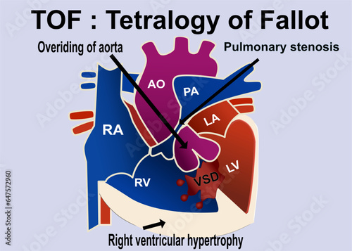 The picture show the structure of tetralogy of fallot that show the 4 part defect of heart which is overriding of aorta , pulmonary stenosis  ,VSD, right ventricular hypertrophy for medical concept