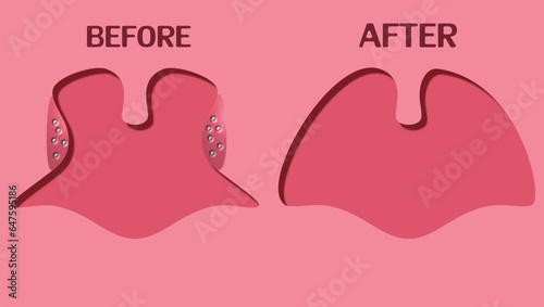 Tonsil surgery before and after, Tonsillectomy