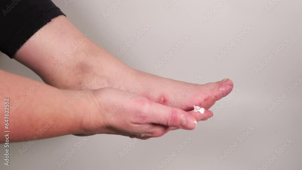 Woman applying steroid or cortisol creme on her foot. Medical treatment of eczema, acute psoriasis, allergic inflammation, dermatological disease. Huge wound on female toes after blisters of eczema. Woman applying steroid or cortisol creme on her foot. Medical treatment of eczema, acute psoriasis, allergic inflammation, dermatological disease. Huge wound on female toes after blisters of eczema.