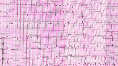 ekg heartbeat pulse rate red grid paper that shows sinus rhythm abnormality of right ventricular hypertrophy. Cardiac fibrillation. Vital sign. Medical healthcare symbol.