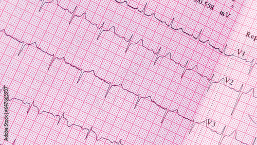 Heartbeat healthcare and medicine, pulse rate red grid paper that shows sinus rhythm abnormality of right ventricular hypertrophy. Cardiac fibrillation. Vital sign. Medical healthcare symbol.