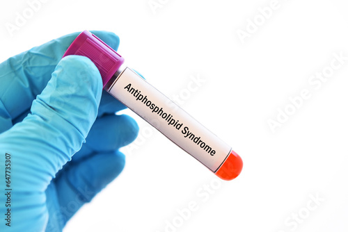 Blood sample tube for antiphospholipid syndrome (APS) test, diagnosis for autoimmune disease photo