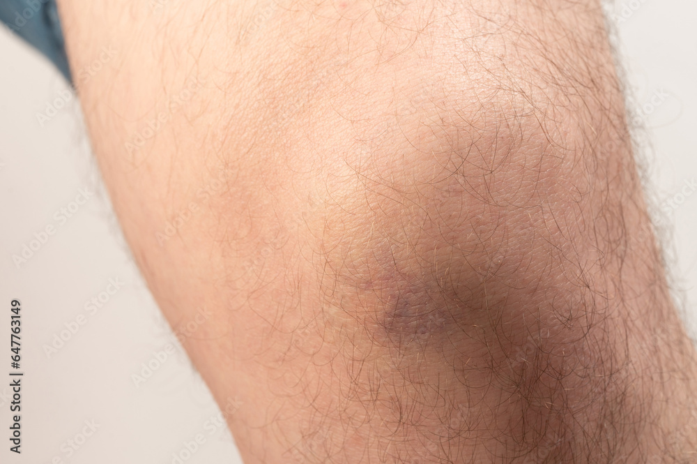 Purple bruise on human knee