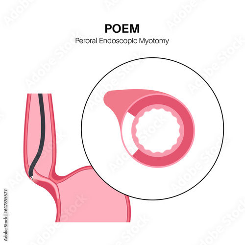 POEM medical poster