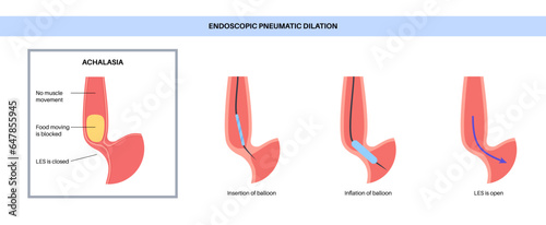 Endoscopic pneumatic dilation
