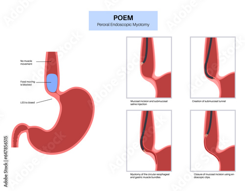 POEM medical poster