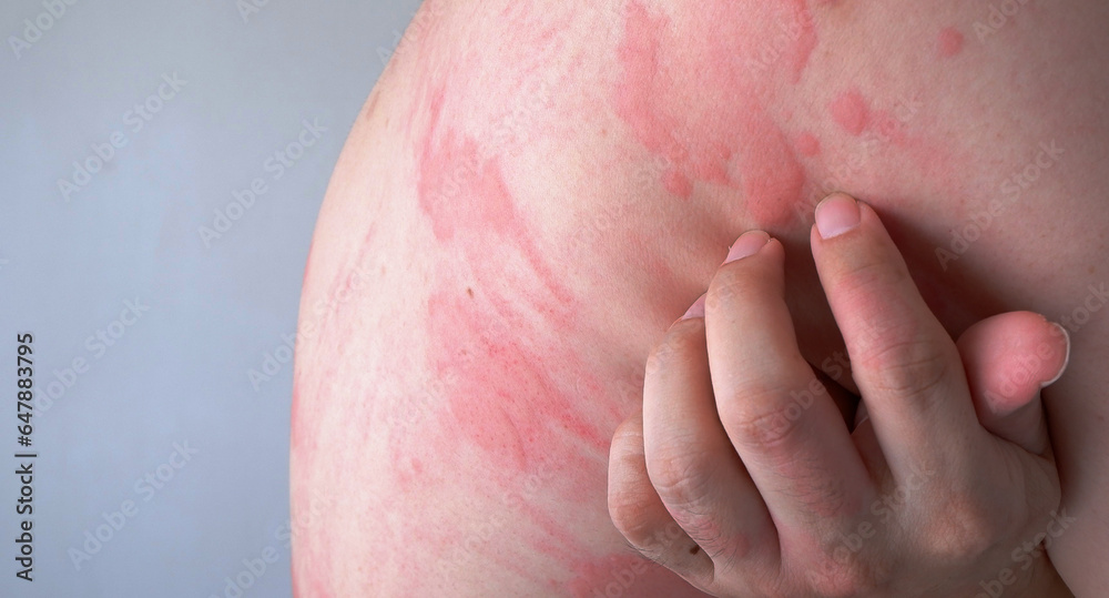 Fototapeta premium Close up image of skin texture suffering severe urticaria or hives or kaligata. Allergy symptoms.