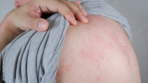 Close up image of skin texture suffering severe urticaria or hives or kaligata. Allergy symptoms. photo