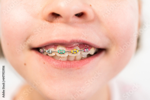 Little girl with rainbow braces