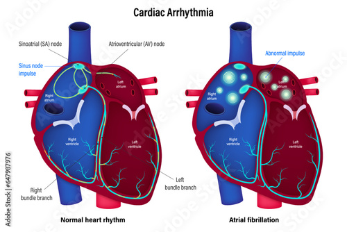 Cardiac Arrhythmia vector. Compare the differences between normal heart rhythm and atrial fibrillation. A heart arrhythmia is an irregular heartbeat. photo