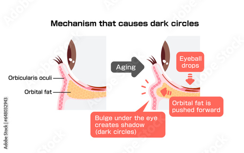 Mechanism of dark circles caused by aging. Vector illustration of cross section.