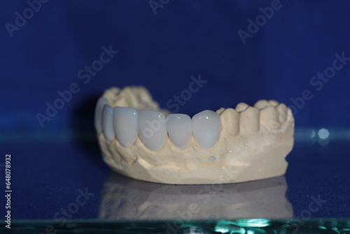 Emax veneers on upper part of the mount. New smile with new teeth