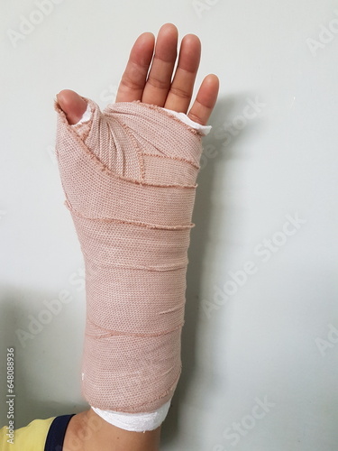 Carpal Tunnel Syndrome post-operative, on a heavy bandage (splint).