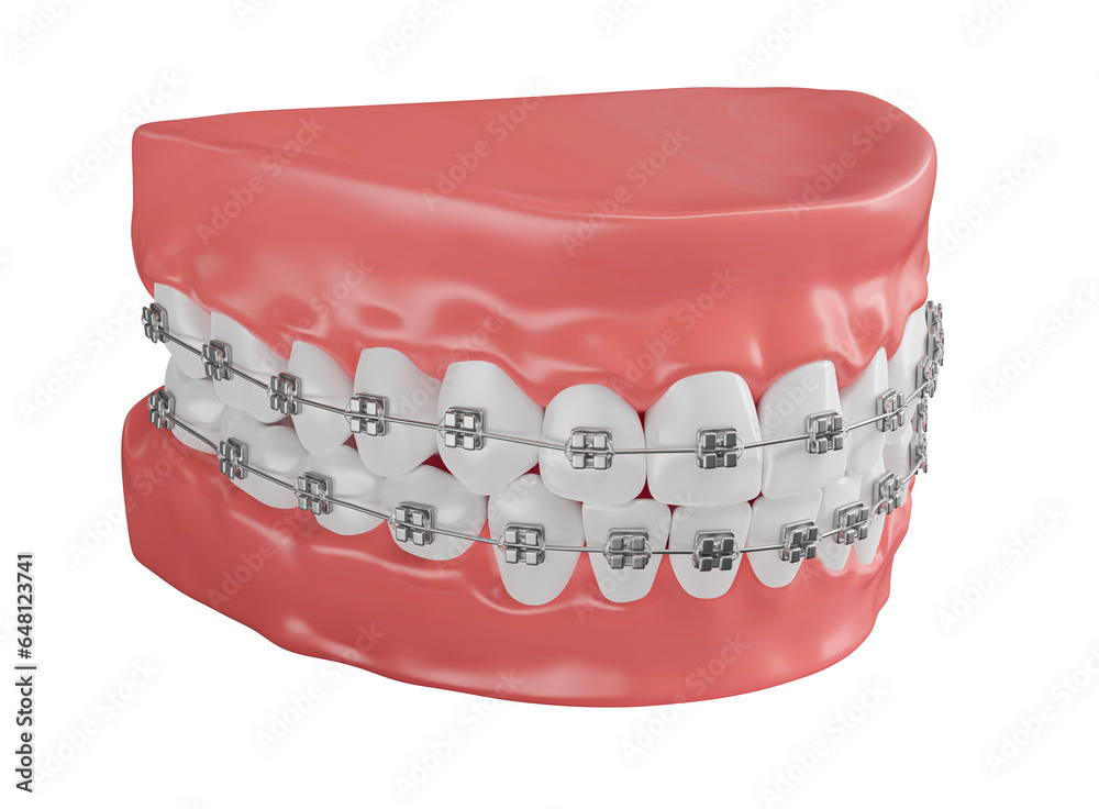 Realistic dental arch with dental braces in on transparent background ...