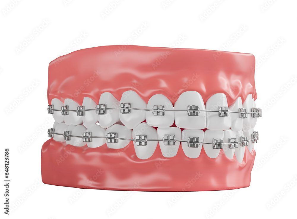 Realistic dental arch with dental braces in on transparent background in 3d render Realistic dental arch with dental braces in on transparent background in 3d render