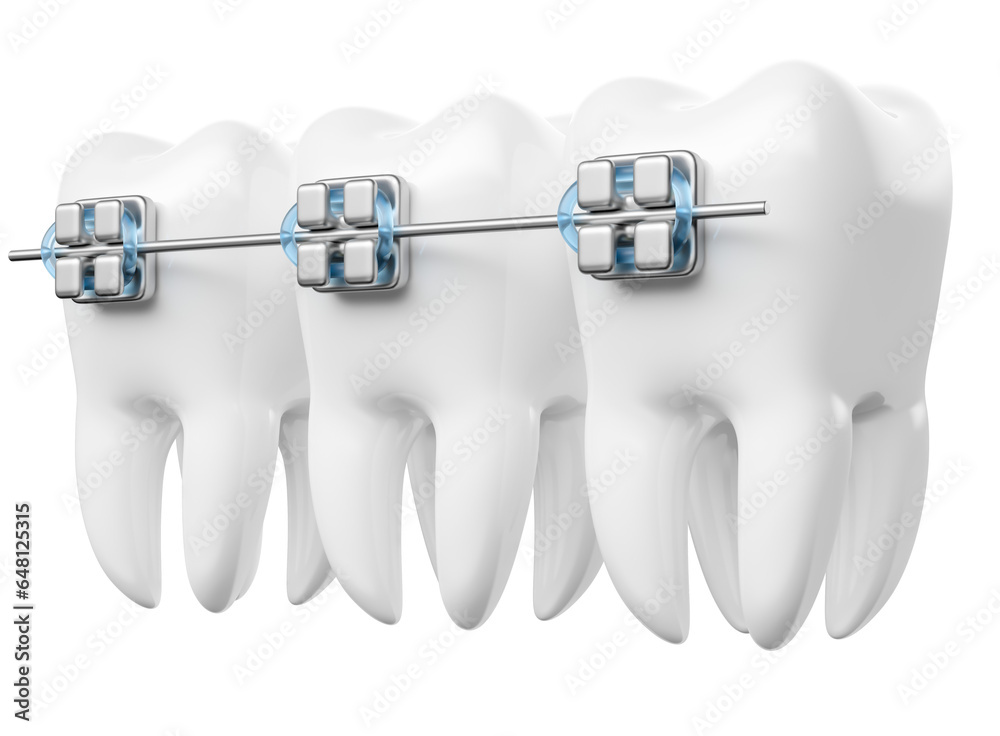 Realistic teeth with dental braces in on transparent background in 3d ...
