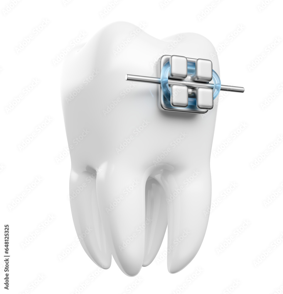 Realistic teeth with dental braces in on transparent background in 3d ...
