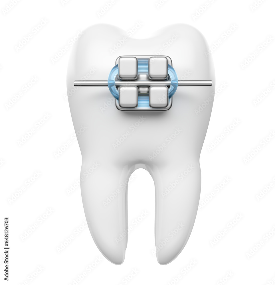 Realistic teeth with dental braces in on transparent background in 3d ...