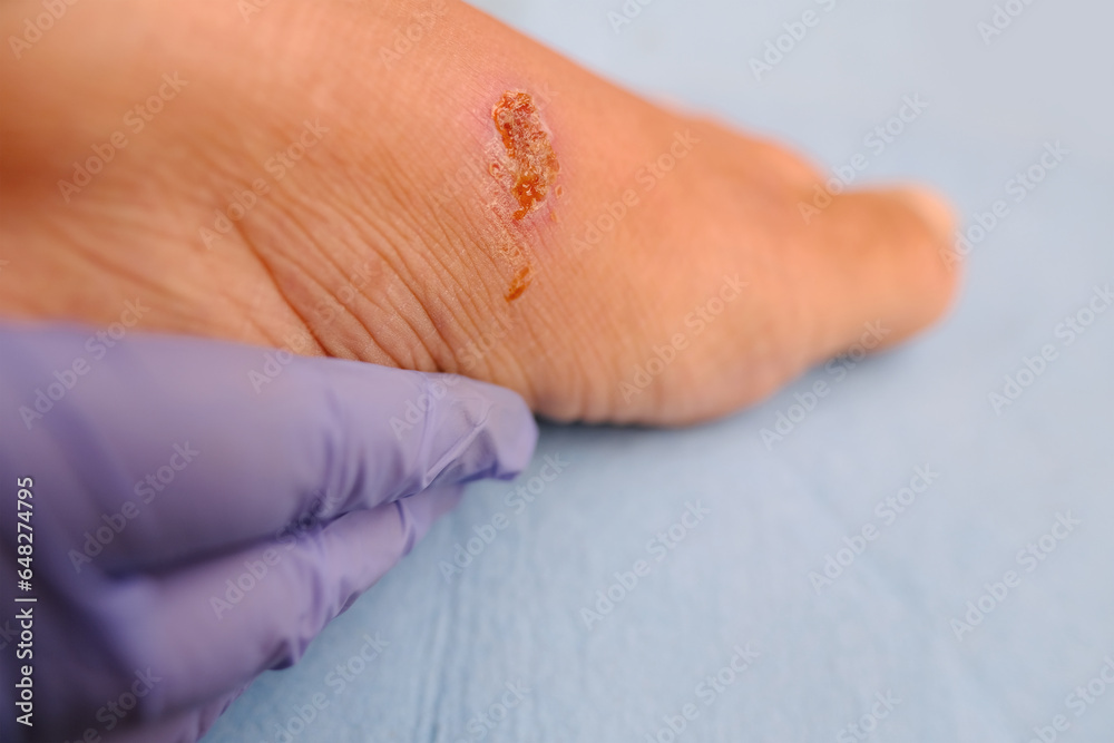 doctor treats weeping wound, trophic ulcer on female leg, wound exudate prevents healing ulcers