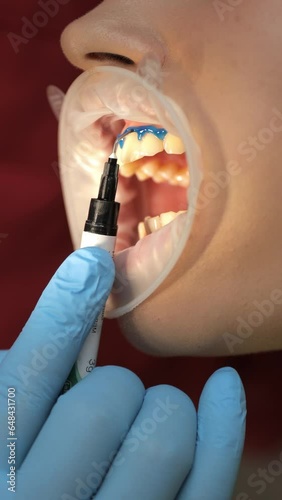 A patient in a dental clinic during a teeth whitening procedure. Vertical video photo