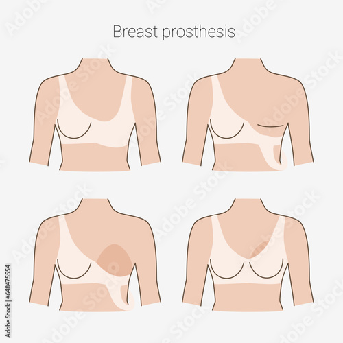 Woman after mastectomy. A girl without breasts tries on a breast prosthesis. Breast cancer. Vector illustration.