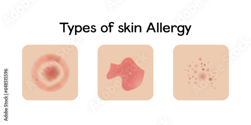 Types of skin allergy vector illustration design photo