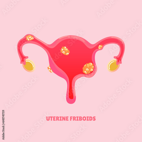 uterine fibroids disease vector illustration
