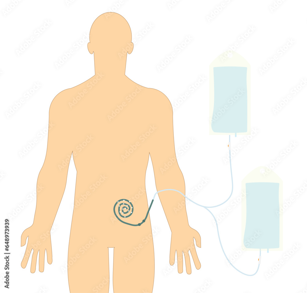 Peritoneal Hemodialysis Illustration Catheter Positioned In The