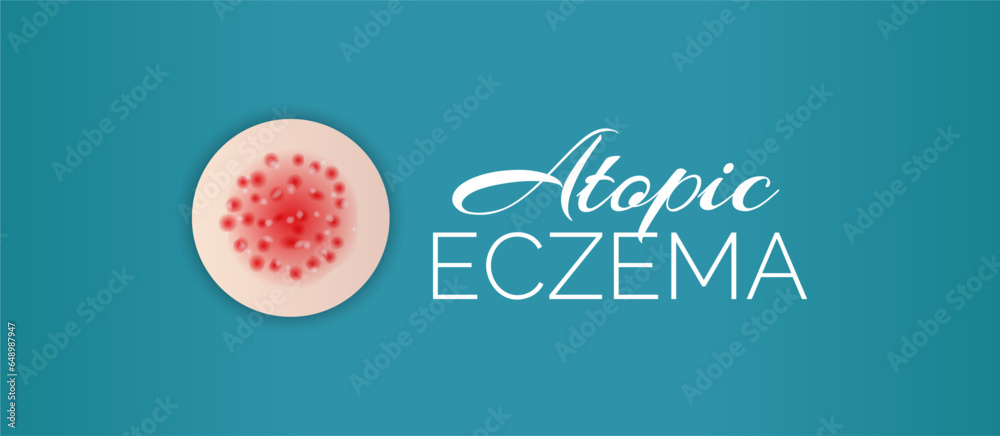 Atopic Eczema Background Illustration Banner Atopic Eczema Background Illustration Banner