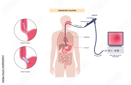 Endoscopic pneumatic dilation