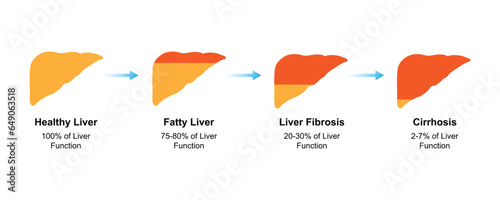 Scientific Designing of Chronic Liver Disease (CLD) Stages. Vector Illustration. photo