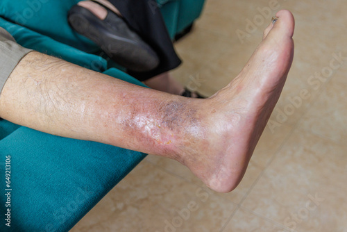 Leg senior person with ulcer due to diabetes photo