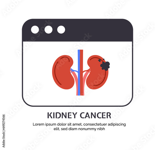 Type of cancer kidney concept. Disease of iternal organ. Healthcare and medicine, treatment. Template, layout and mock up. Cartoon flat vector illustration isolated on white background photo